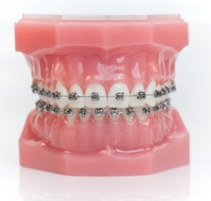 Damon_Braces_Typodont san diego orthodontics